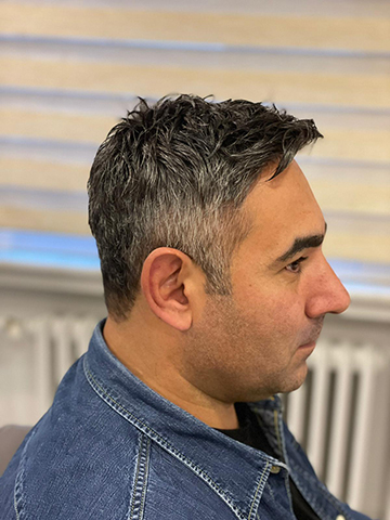 Hair Hotel erkek önce sonra