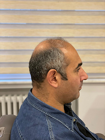 Hair Hotel erkek önce sonra