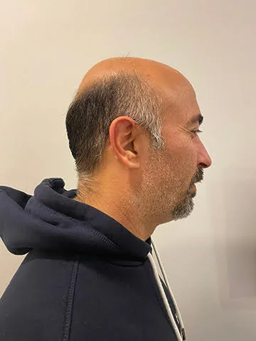 Hair Hotel erkek önce sonra